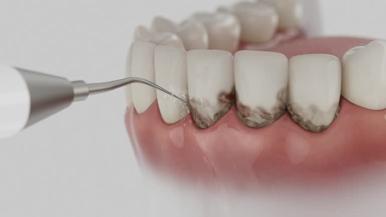 Trusted Dental Crowns And Bridges service in Champaign, IL - Dentist Open Now